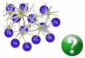 Depositi di ferro cerebrale in paziente con sclerosi multipla